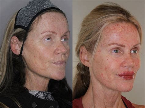 Facial Rejuvenation Before and After Pictures Case 169 | Atlanta, Georgia | Buckhead Facial ...