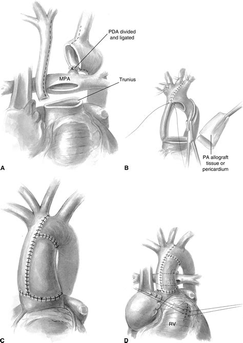 Repair of Truncus Arteriosus With Interrupted Aortic Arch - Operative Techniques in Thoracic and ...