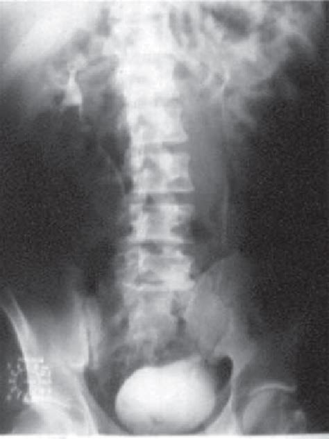 Computed tomography scan of the abdomen showing a large, well-defined,...