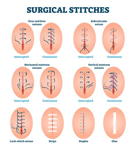 Premium Vector | Surgical stitches illustration. Labeled various cut ...