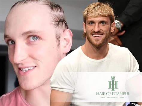 Logan Paul Hair Transplant: Did He Redefine His Look? - Hair of Istanbul Hair Transplant Clinic