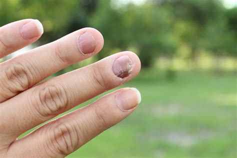 What Causes Nail Psoriasis? – Nuvothera™
