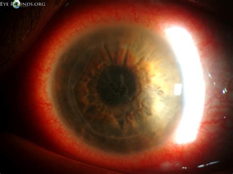 Atlas Entry - Herpes simplex virus (HSV) geographic epithelial keratitis