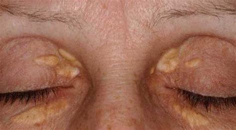 XANTHELASMA | Optometry Today