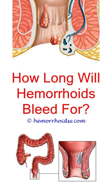 What Doctor Treats Hemorrhoids? | Bleeding hemorrhoids, Getting rid of ...