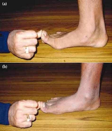 (a) Positive and (b) negative great toe extension test. | Download Scientific Diagram