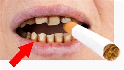 Can Orthodontist Tell If You Vape – SkinTots.com