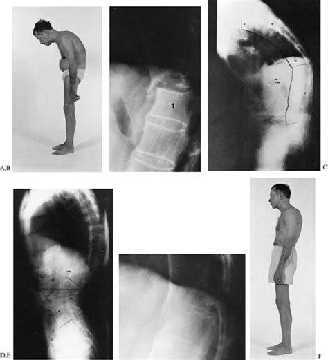 SURGERY OF THE SPINE IN ANKYLOSING SPONDYLITIS - TeachMe Orthopedics