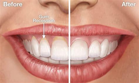 Gum Recession Symptoms And Treatment - Smile Team Turkey