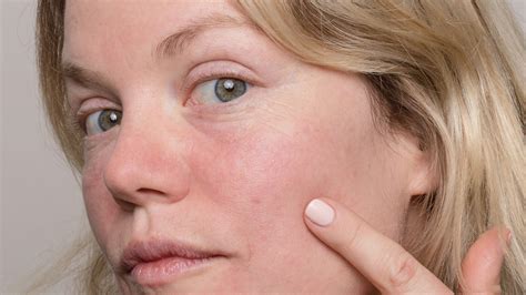 TREATING ATROPHIC ACNE SCARS