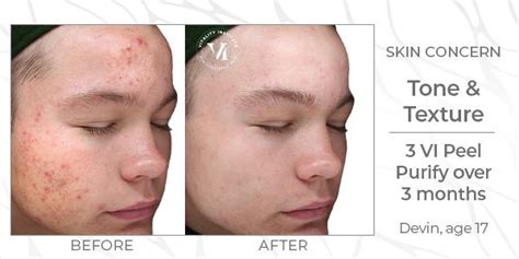 VI Chemical Peel | Anti-Aging Treatment For Acne Scars, Breakouts & More