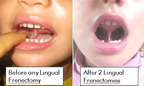 Lingual-Frenectomy-Before-After - Debug Your Health