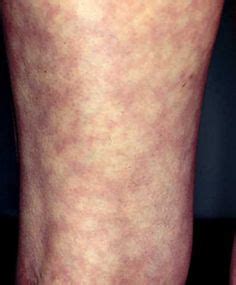 livedo reticularis on Pinterest