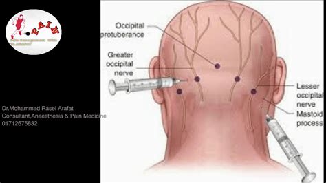 Greater Occipital Nerveblock | #Greateroccipital#nerve#Headache# ...