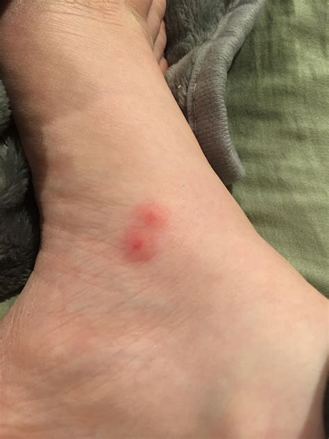 Any idea if these could be bed bug bites? I have two similar spots on the inside of my wrist ...