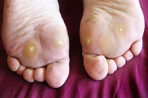 What Triggers Plantar Warts and How Do You Treat Them?