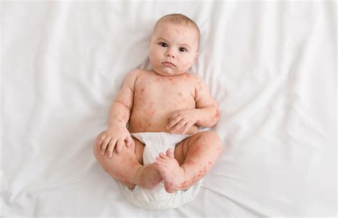 Measles In Babies: What To Look Out For | Childhealthy London