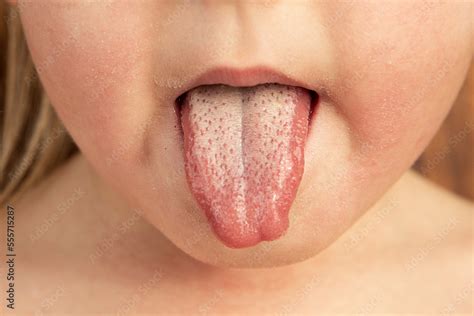 Strawberry tongue of a small child with scarlet fever caused by group A streptococcus Stock ...