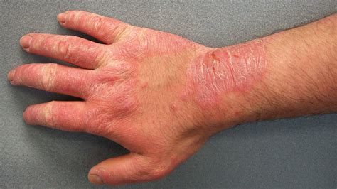 CAUSES AND TREATMENT OF DISCOLORED SKIN PATCHES - Health GadgetsNG