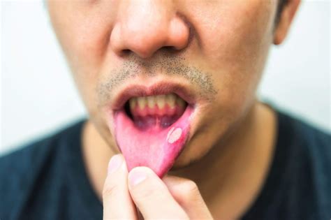 Mouth ulcers - causes and treatments | Dentek