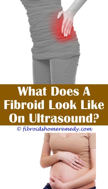 Can Fibroids Burst And Bleed | Uterine fibroids treatment, Fibroid cyst ...