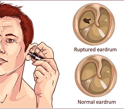 Hole in Eardrum- Causes, Symptoms, Diagnosis, Surgery, Recovery