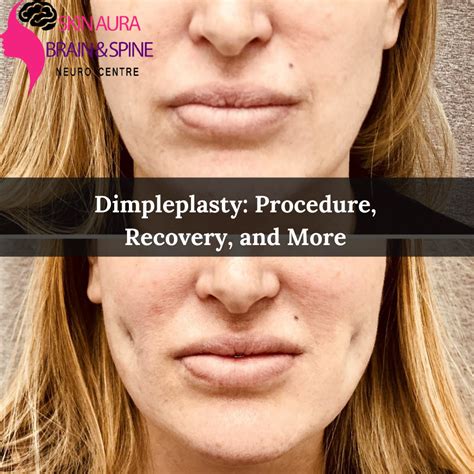 SAB Clinic - Dimpleplasty: Procedure, Recovery, and More - IssueWire