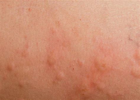 Chlorine Rash - Pictures, Symptoms, Causes, Treatment