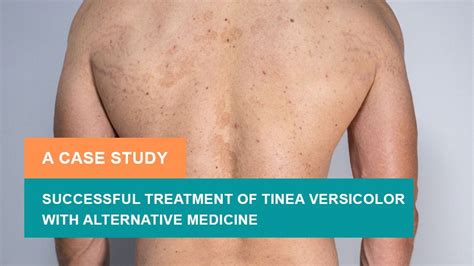 Successful Treatment of Tinea Versicolor with Alternative Medicine - A Case Study