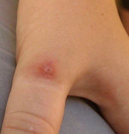 Pictures, Symptoms, and Treatment of Black Widow Spider Bites - HubPages
