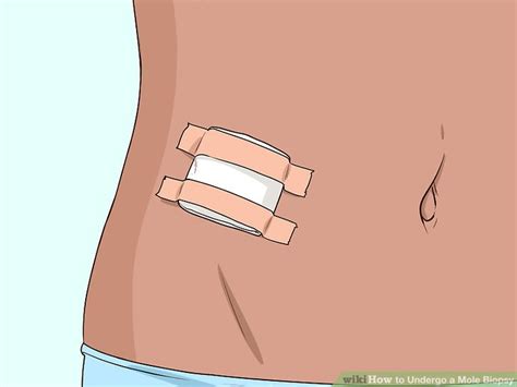 3 Ways to Undergo a Mole Biopsy - wikiHow Health