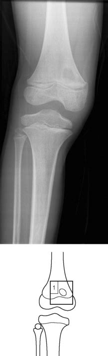 Brodie’s abscess | Radiology Key