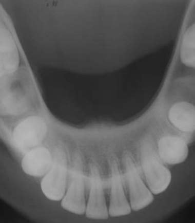 OCCLUSAL RADIOGRAPH 1 | Buyxraysonline