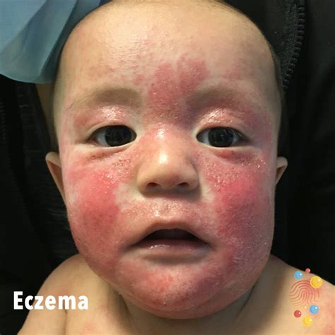 Eczema - Skin Deep