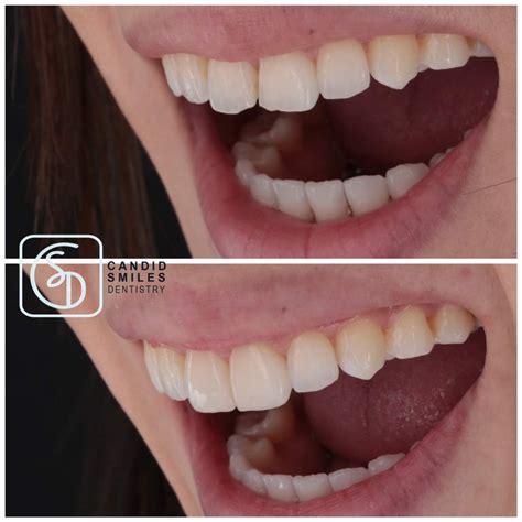 Composite Veneers — Candid Smiles Dentistry | Cypress Biological Dentist | Cosmetic Dentist