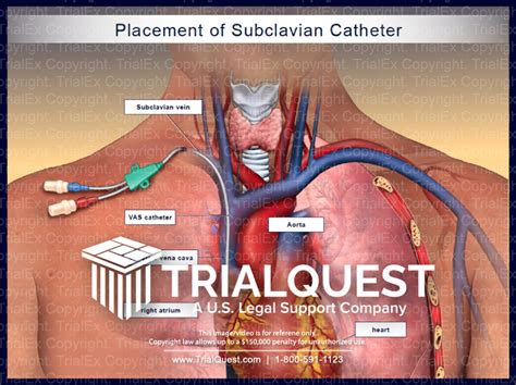 Triple lumen catheter vs picc line - nerystep