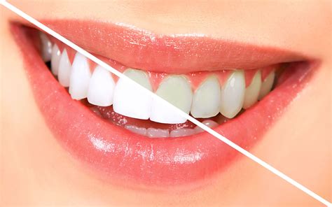 Teeth Whitening - Guide To a Beautiful Smile - DentalsReview