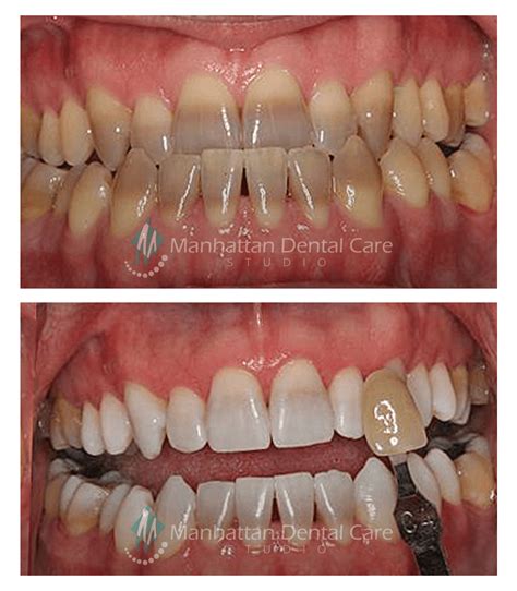 Cosmetic Teeth Whitening Before And After - Teeth Poster