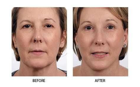 Premier Facial Plastic Surgery by Dr. William Numa in Boston