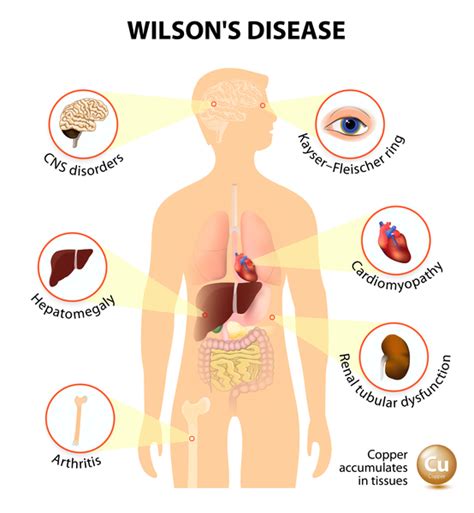 Detailed Description of Wilson Disease by Dr Arun Aggarwal Gastroenterologist