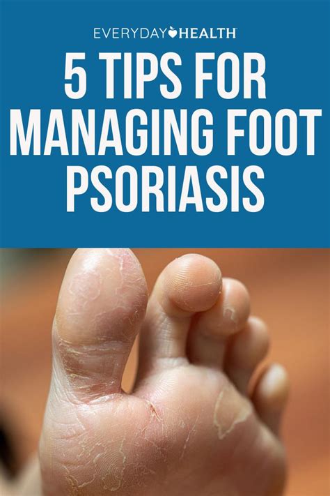 Tips for Managing Foot Psoriasis | Everyday Health in 2021 | Psoriasis ...