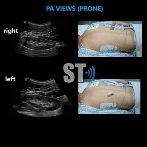 Renal Ultrasound Complete Protocol – Sonographic Tendencies