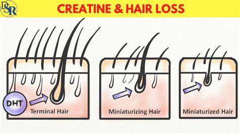 👉 Creatine & Hair Loss - Real Scientific TRUTH! - YouTube