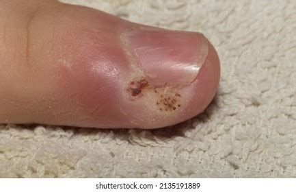 Whitlow Felon Infection Tip Finger Stock Photo (Edit Now) 2135191889