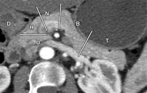 Multidetector CT Evaluation of the Postoperative Pancreas | RadioGraphics