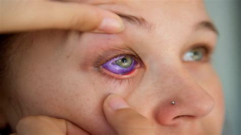 Eyeball Tattoo Removal | Tattoosketche.com