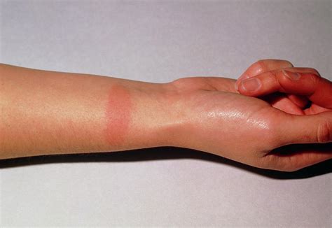 Allergy Reddening Due To Leather Wrist Strap Photograph by James Stevenson/science Photo Library ...