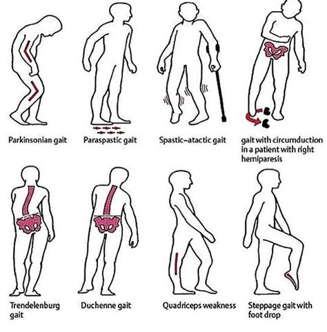 Types of gait | Physical therapy exercises, Physical therapy student, Physical therapy assistant