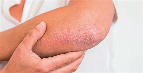 Profil Pasien Psoriasis Vulgaris - Unair News