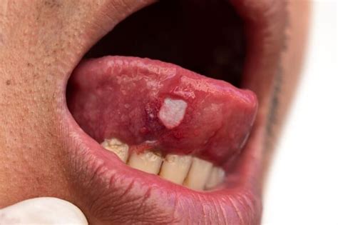 When harmless mouth ulcers are actually more serious ...